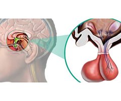 Un nuevo síndrome causa discapacidad intelectual y propensión a la obesidad